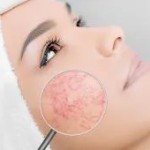 Hud med couperose: Symptomer, behandling, og skønhedsprodukter